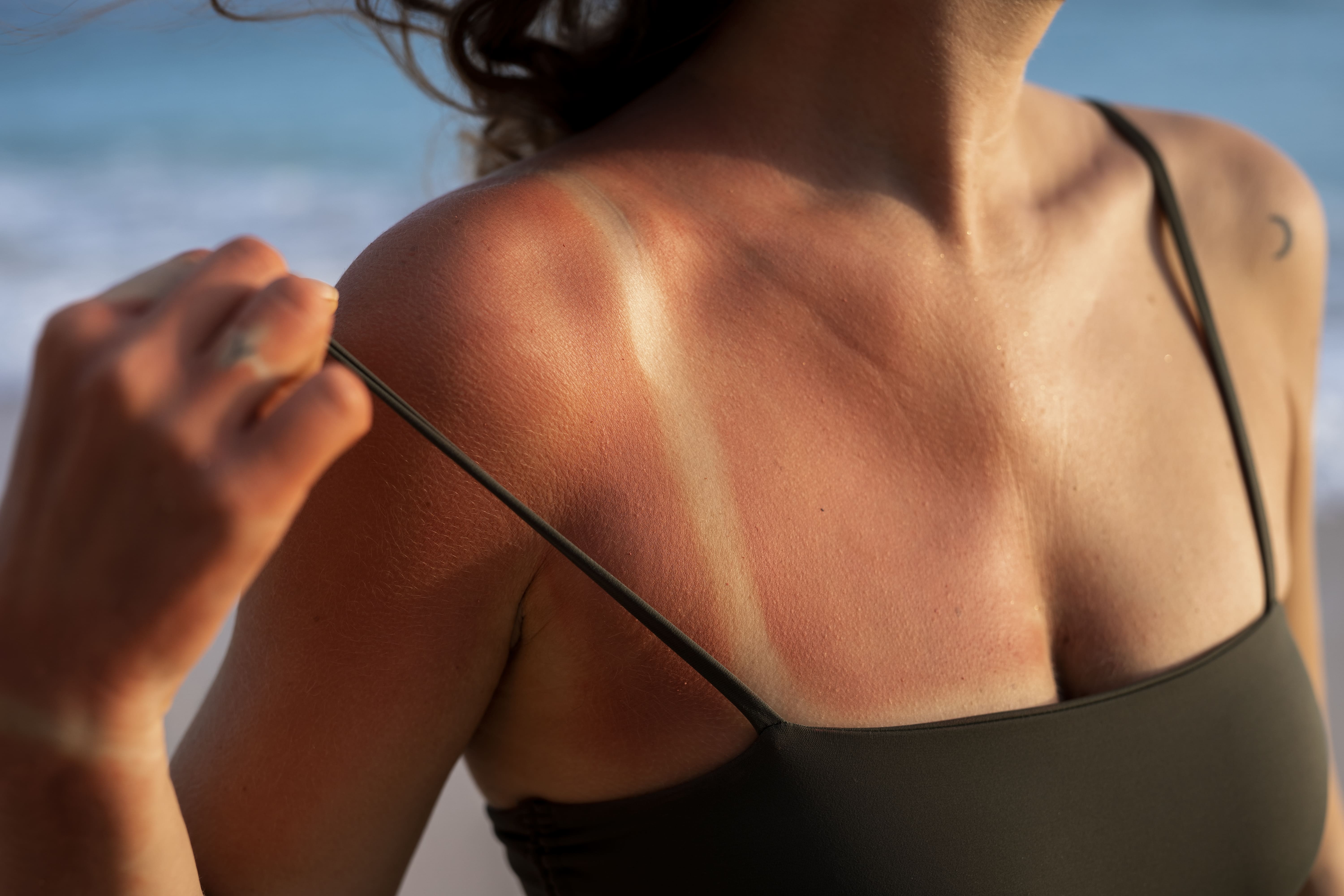 Imagem de mulher com queimadura de sol